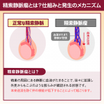 精索静脈瘤とは？仕組みと発生のメカニズム