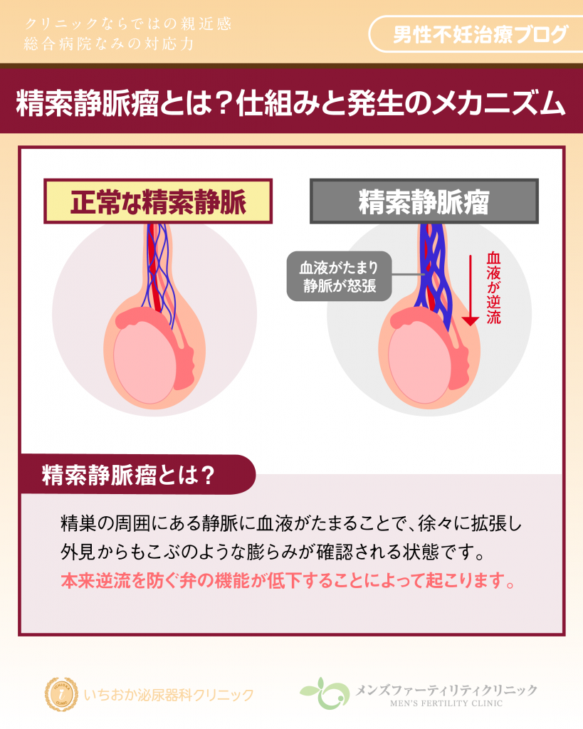 精索静脈瘤とは？仕組みと発生のメカニズム